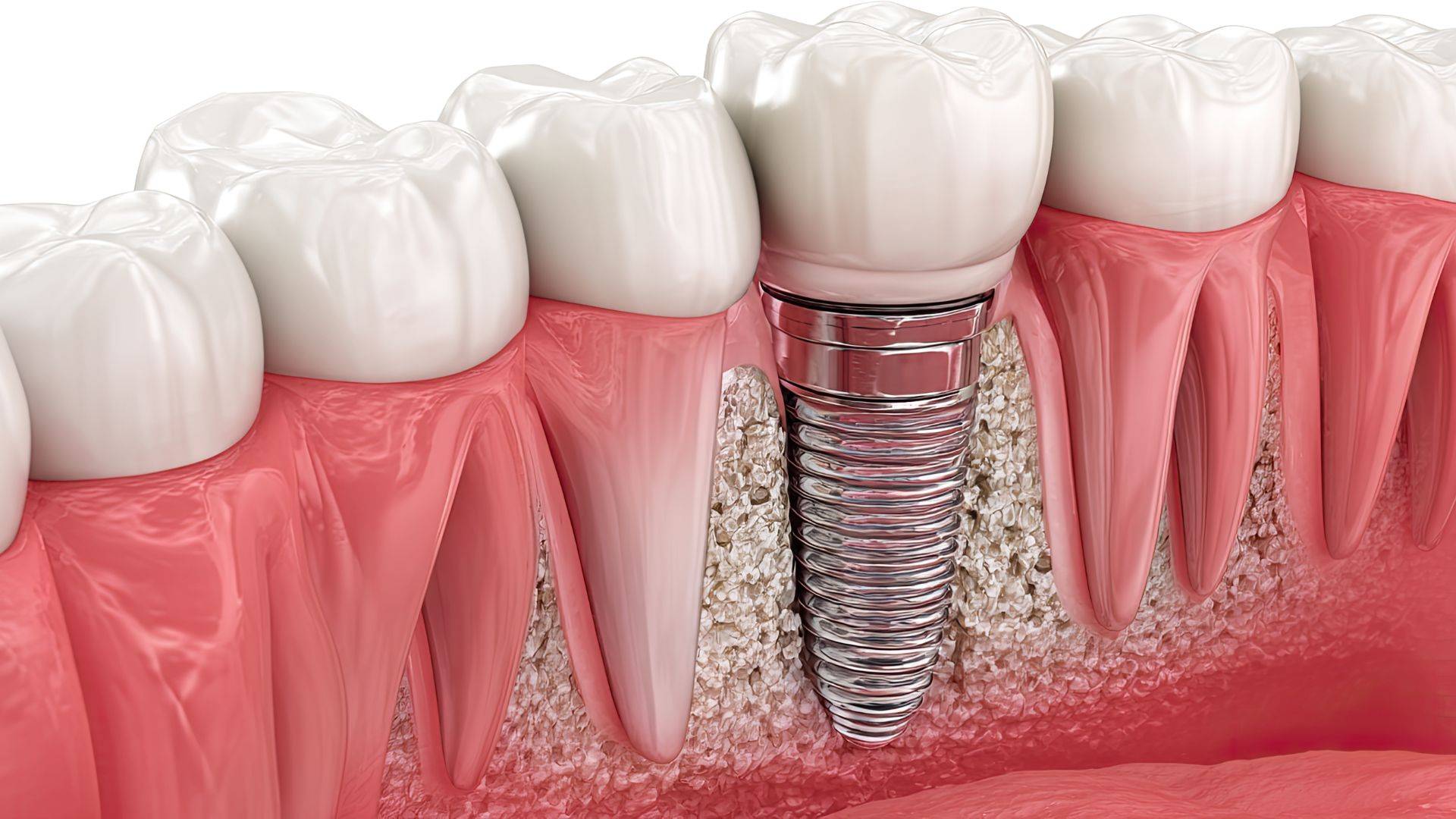 Cât rezistă un implant dentar