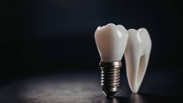 implant dentar