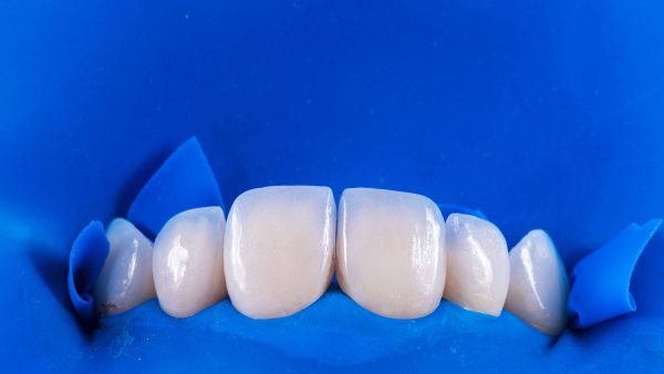 recomandare fatete dentare Brasov