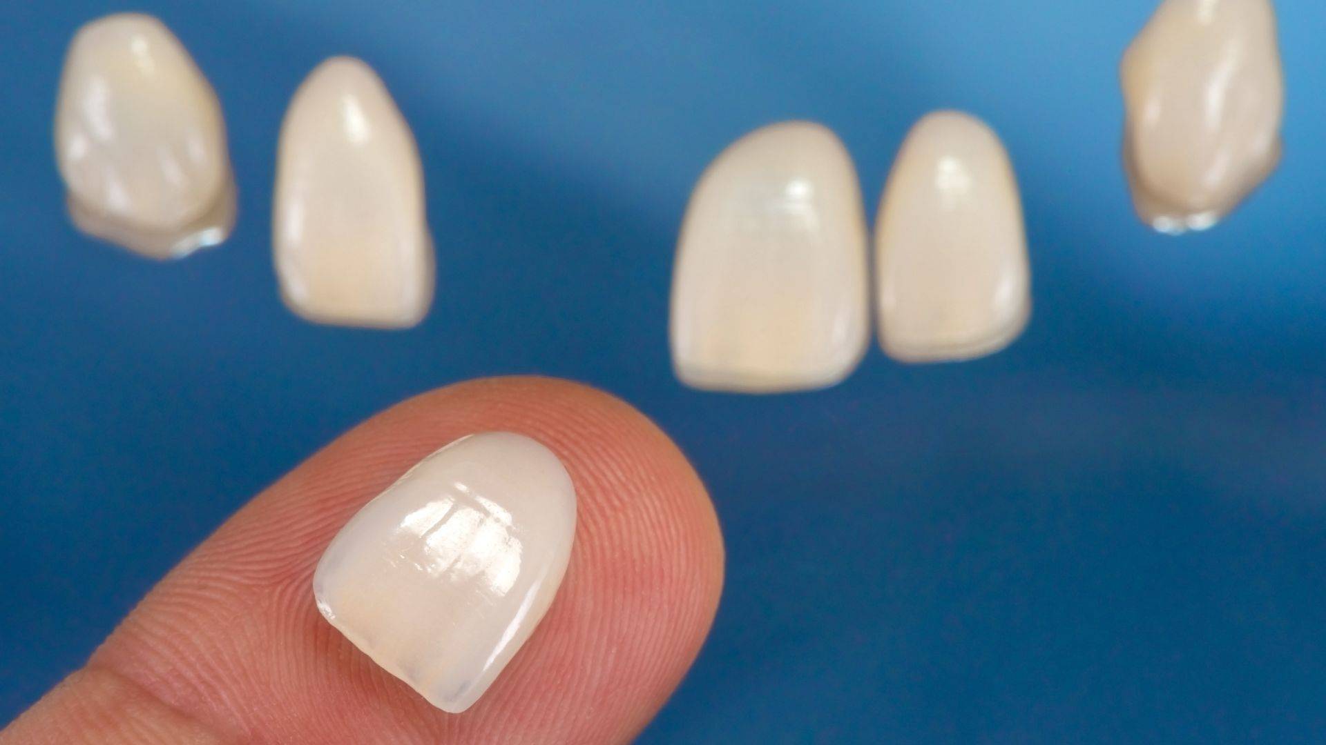 Când se recomandă fațetele dentare?